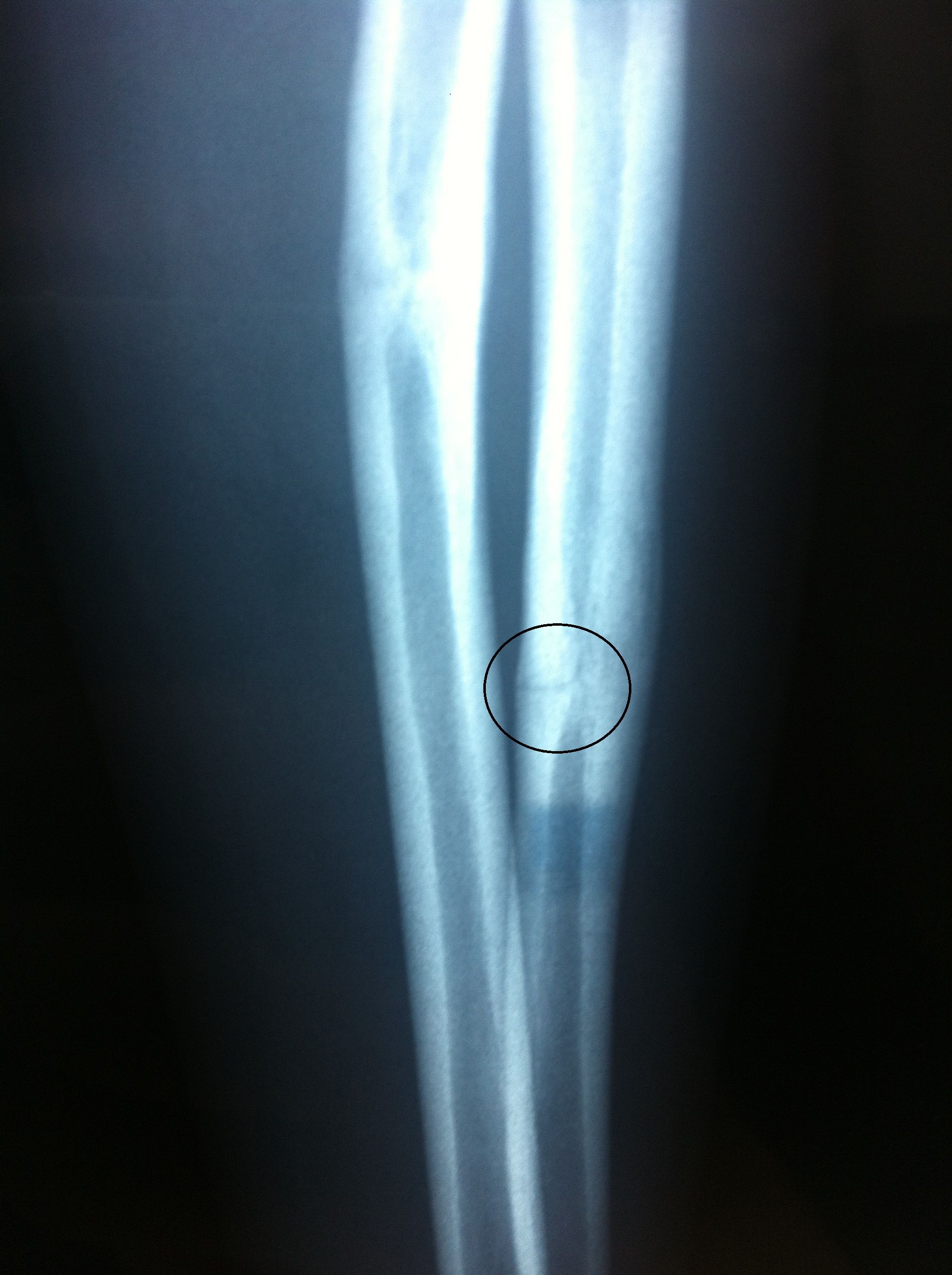 天智航获得发明专利授权:“手骨骨折处置钉通道的智能化规划方法和装置”